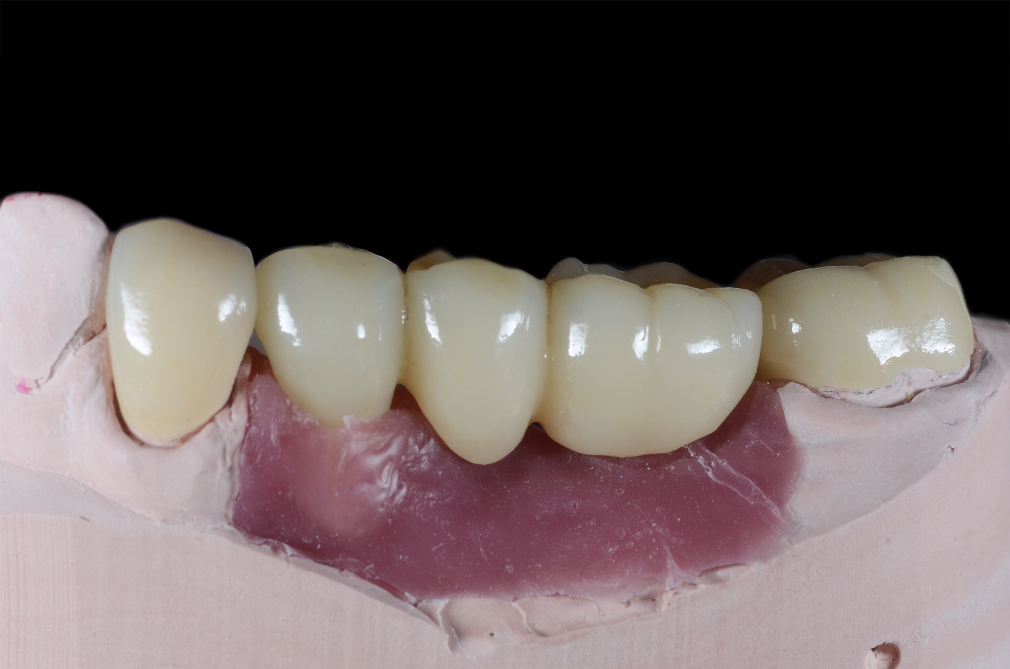 Zirconia Implant Bridge and Crowns on Angulated Abutments